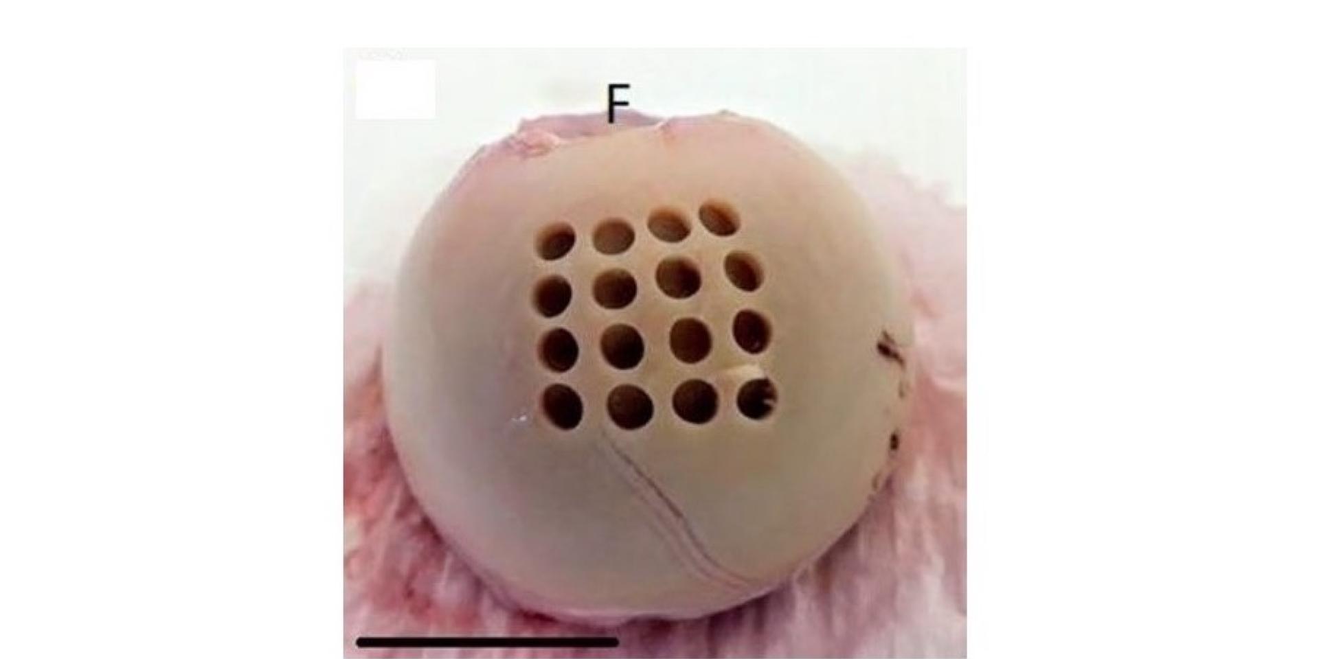 Figure 2. A human femoral head with small circular ‘wells’ prepared in the cartilage into which MSCs are placed and then stimulated to generate new cartilage. (F indicates the fovea and the source of the foveal ligament. Scale bar is 25mm).